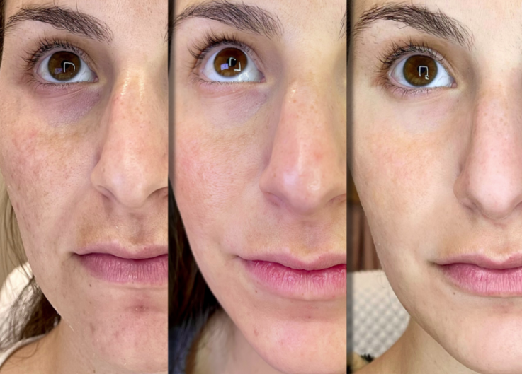 Collagen Before And After Pictures Do You See The Difference 